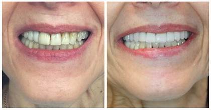 Dental Bridge Dubai