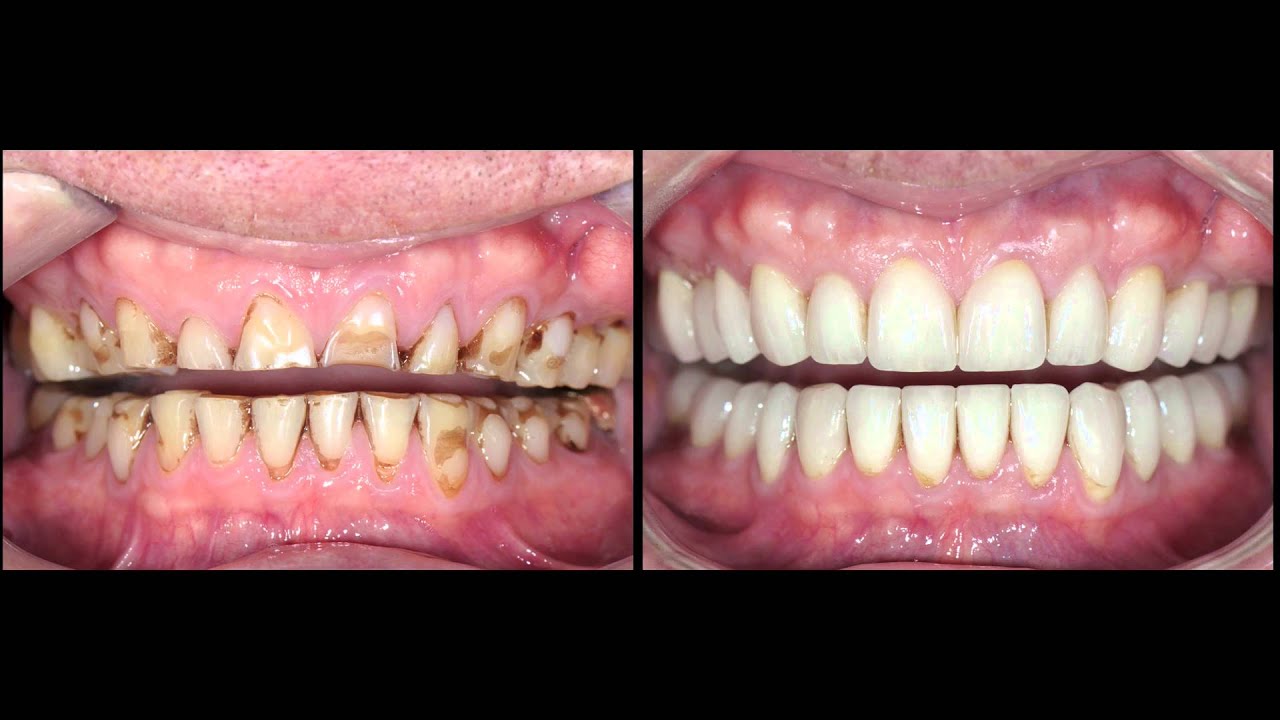 Dental Bridge Dubai