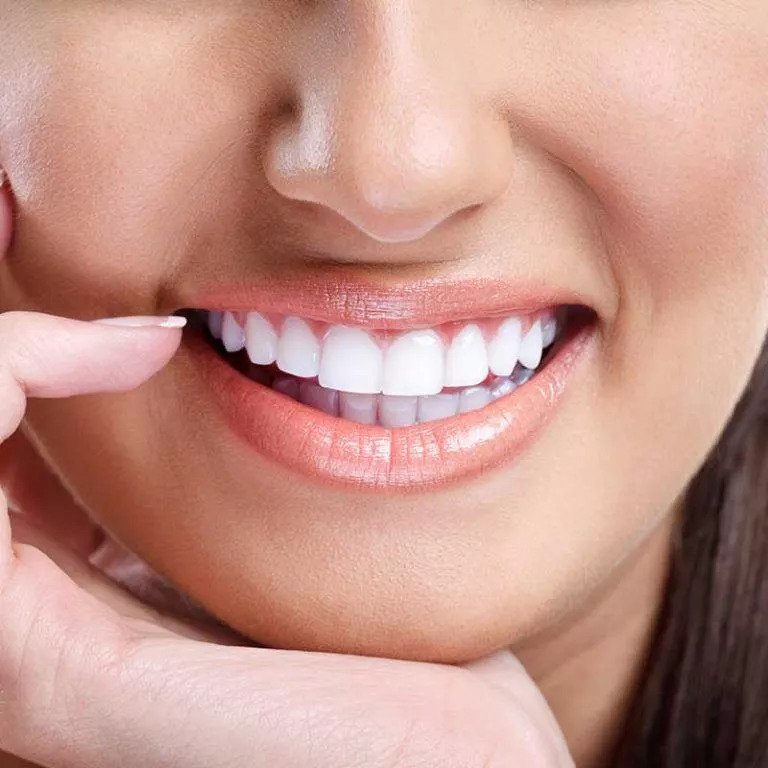 Veneers Services